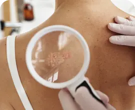 banner câncer de pele não melanoma